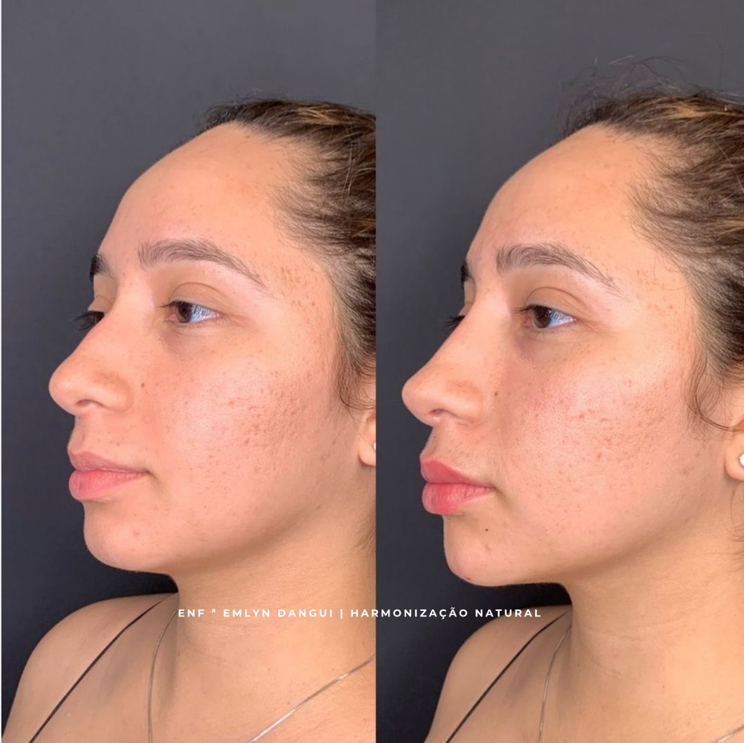 Resultado de tratamento estético facial