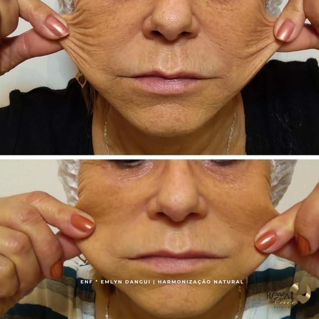Resultado de tratamento estético facial